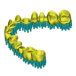 hyperDENT Additive Sintered Dental Bridge